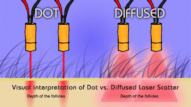 Illustration of diffused vs. dot lasers --you want DIFFUSED LASERS when you are fighting hair loss!