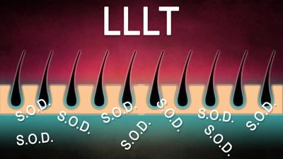 LLLT produces Superoxide Dismutase -and it's time related!
