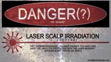 Laser Safety -is laser therapy / LLLT for hair loss safe?