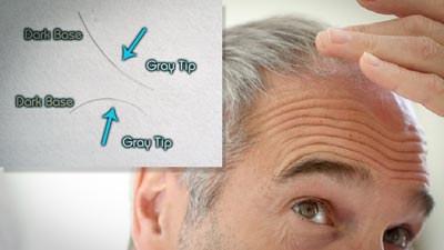 LLLT / Laser Therapy reduces gray hair!