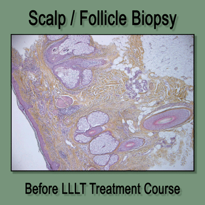 Animated Before-After Scalp Biopsy of Laser Therapy Reducing Inflammation